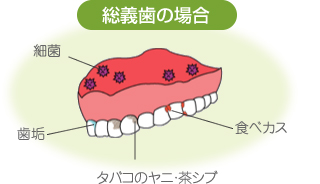 総義歯の場合の汚れ